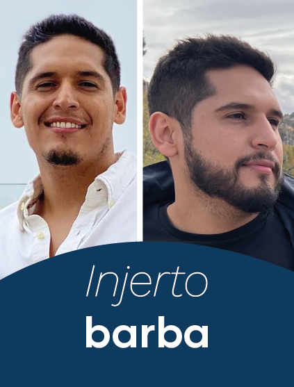 Injerto de Barba